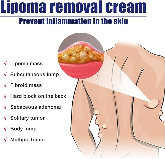 LIPOMA REMOVAL CREAM (IMPORTED) - Image 3