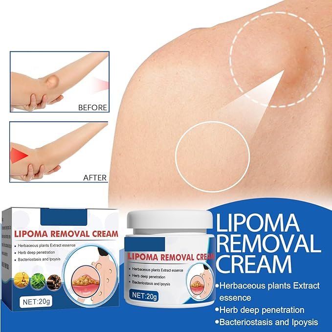 LIPOMA REMOVAL CREAM (IMPORTED) - Image 5