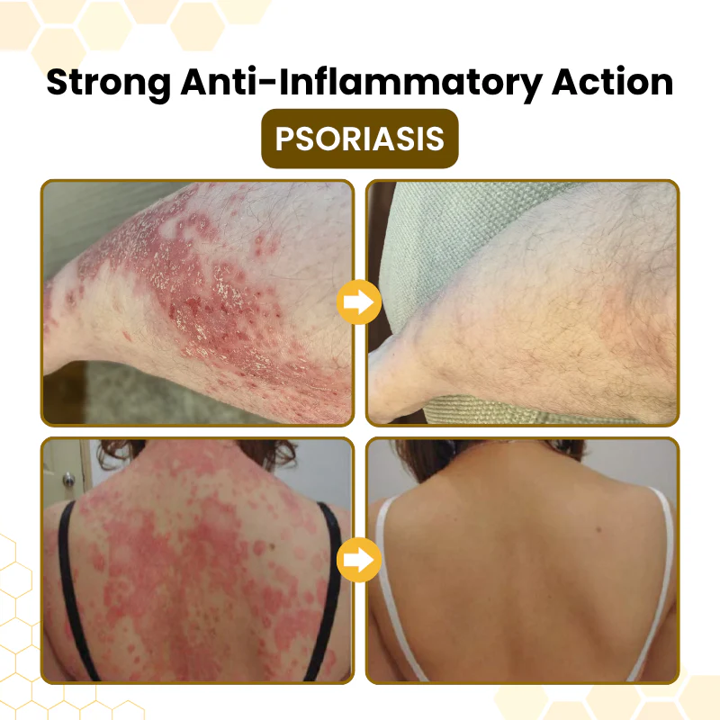 PsoriaSoothe Skin-Restoration Cream - Image 3