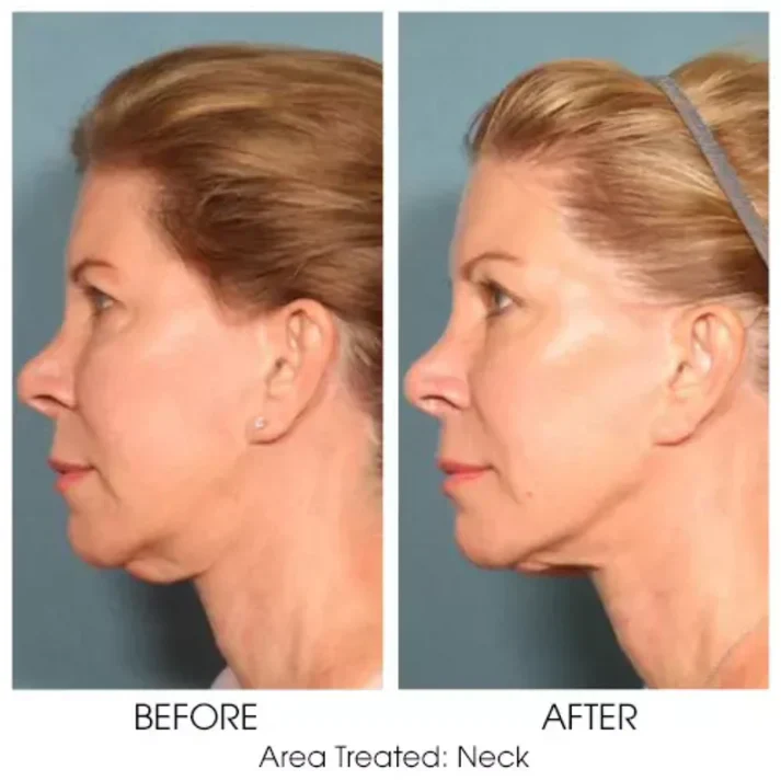 Magec Collagen Fullerene Neck Cream - Tightening & Anti-Wrinkle Formula - Image 6