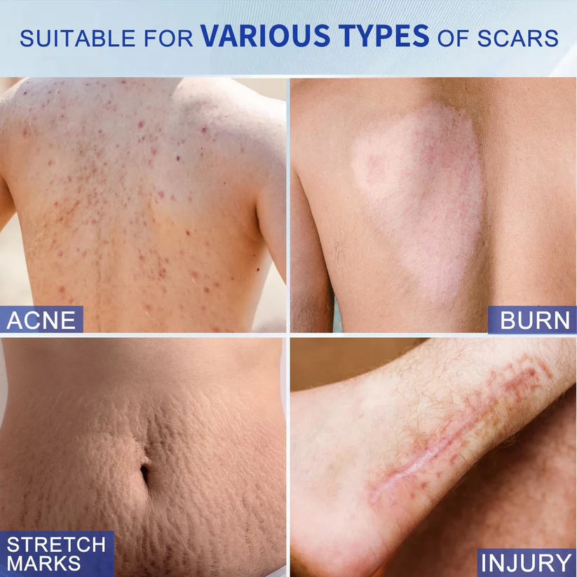 Scar Removal Gel for Old and New Scars - Image 7