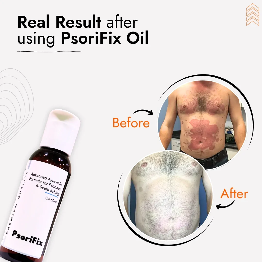 Natural Oil for Psoriasis & itching (for Day Use) - Image 6