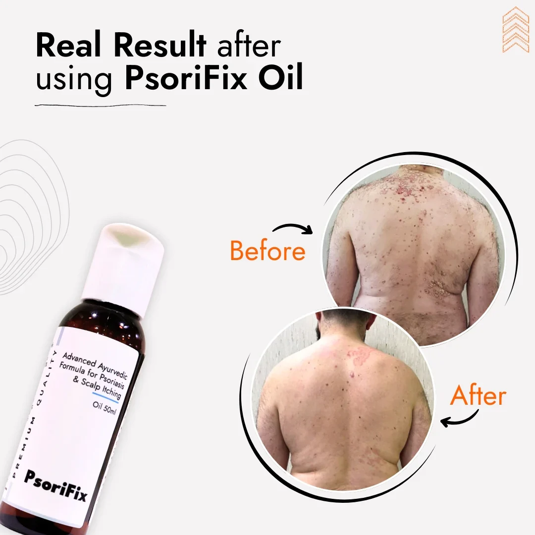 Natural Oil for Psoriasis & itching (for Day Use) - Image 5