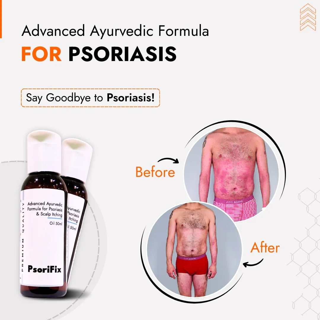 Natural Oil for Psoriasis & itching (for Day Use) - Image 4