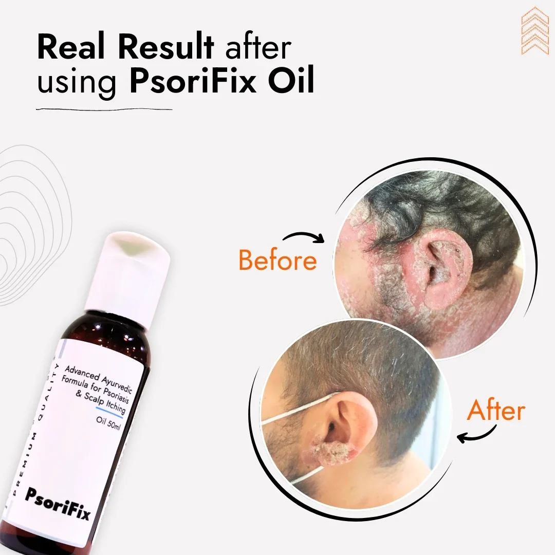 Natural Oil for Psoriasis & itching (for Day Use) - Image 3